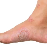 Kondisi Borok Atau Luka Pada Kulit Yang Cukup Banyak