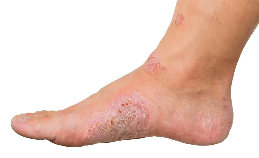 Kondisi Borok Atau Luka Pada Kulit Yang Cukup Banyak